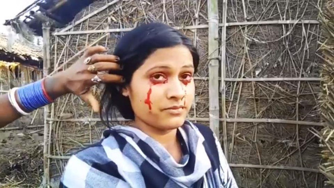 Mau tu chay khoi co the 5 lan/ngay dao lon cuoc song cua be gai 8 tuoi-Hinh-2