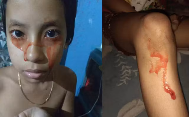 Máu tự chảy khỏi cơ thể 5 lần/ngày đảo lộn cuộc sống của bé gái 8 tuổi Mau tu chay khoi co the 5 lan/ngay dao lon cuoc song cua be gai 8 tuoi