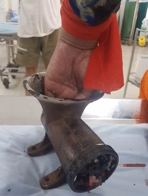 Nguoi phu nu bi may xay thit ‘nuot’ gan het ban tay