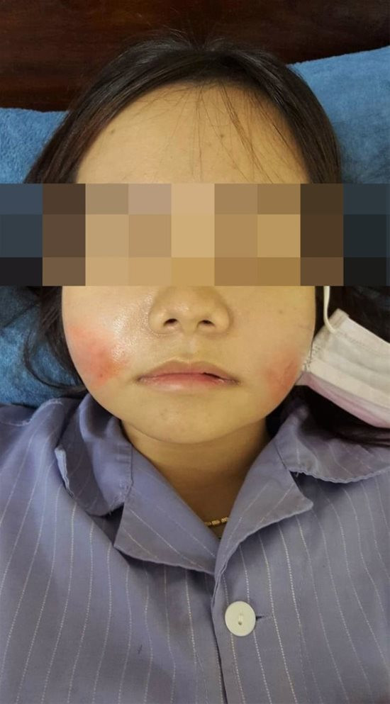 Bien chung vi tiem filler lam dep, chi em thay nhau vao vien