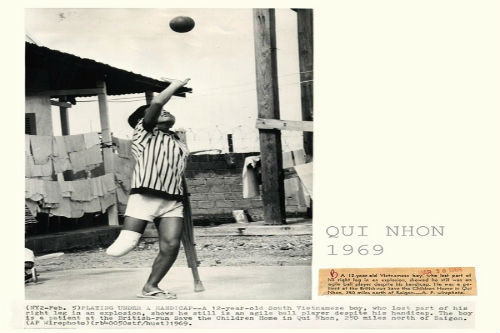 Em bé ở Quy Nhơn bị mất đi một bên chân do bom đạn. (Ảnh AP).