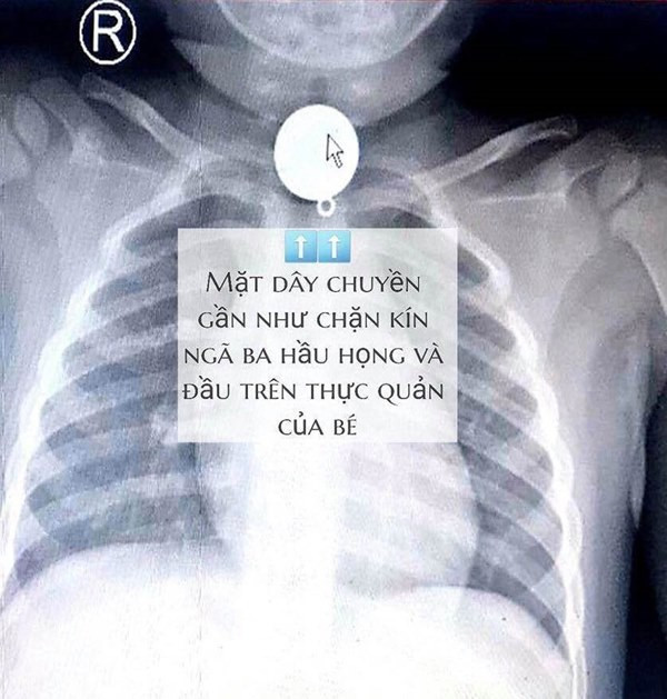 Be trai 2 tuoi suyt chet vi thoi quen deo day chuyen cho con