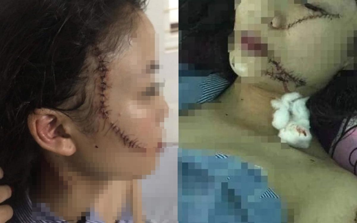 Tam su dam nuoc mat cua chi co gai bi tan cong phai khau 60 mui