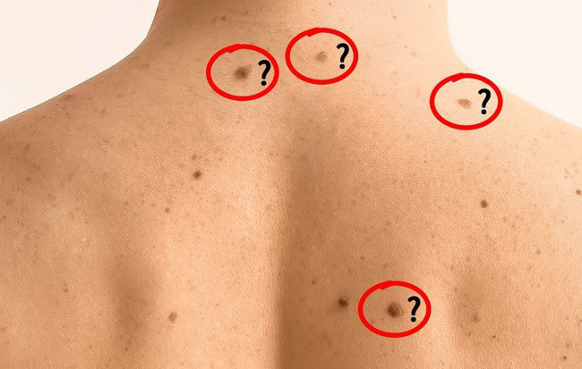 Dau hieu thay doi bat thuong cua not ruoi canh bao benh nguy hiem