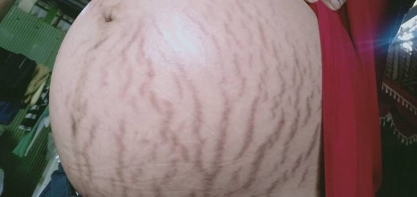 Dan mang nem da chong che bung bau ran cua vo la 