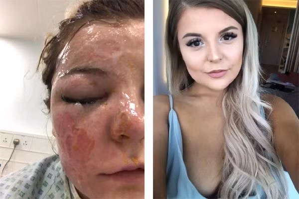 Rosser (phải) trước tai nạn và một nửa khuôn mặt bị bỏng nặng vì nổ trứng. Ảnh: The Sun