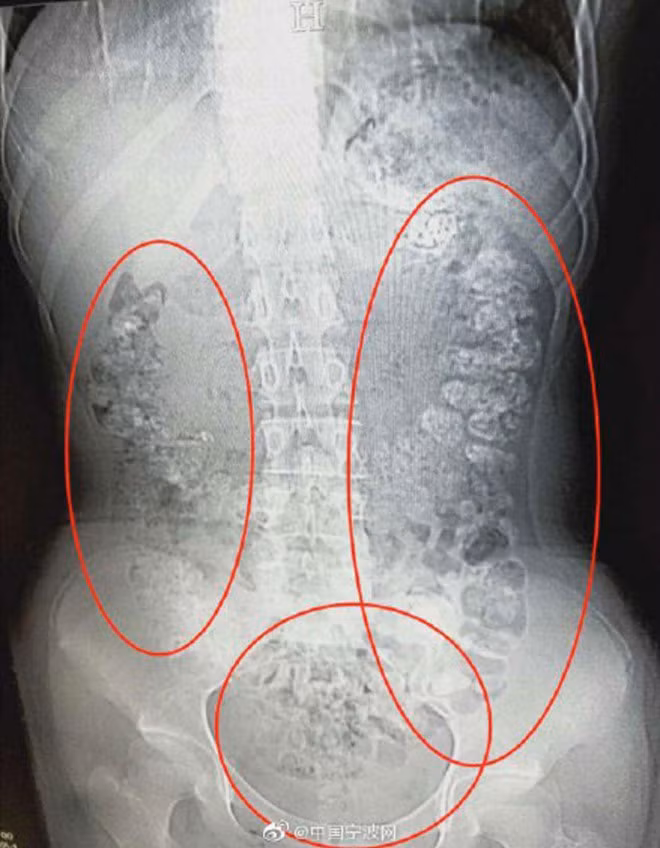 Co gai nhap vien vi khong tieu hoa het tran chau trong tra sua