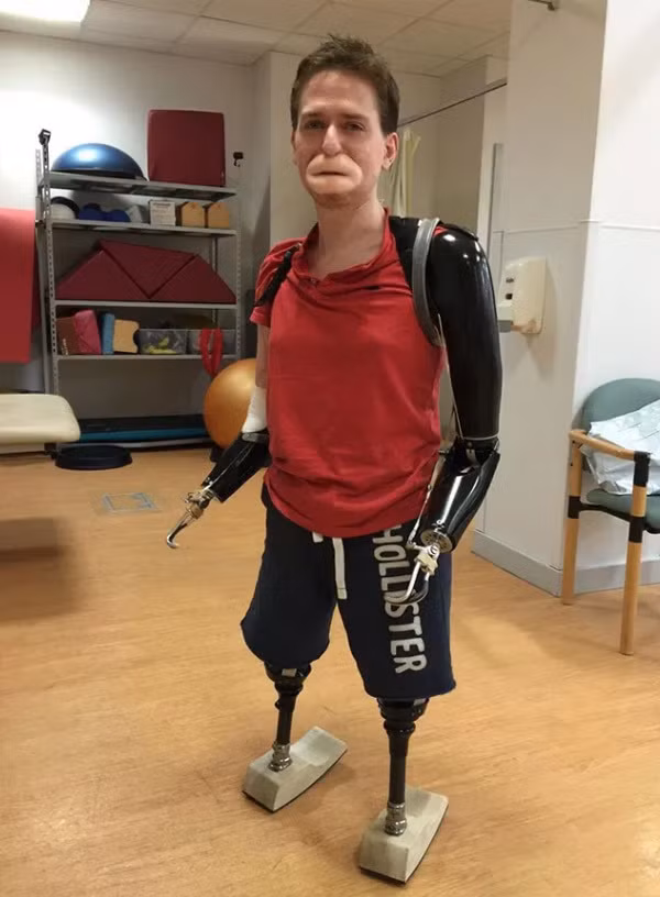 Cắt bỏ môi và tứ chi vì nghĩ mình bị cảm cúm thông thường - Hình 2 Cat bo moi va tu chi vi nghi minh bi cam cum thong thuong-Hinh-2