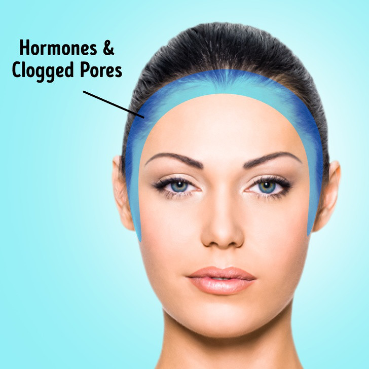 Mụn ở “viền” khuôn mặt: Mụn xuất hiện dọc đường chân tóc và gần tai có thể là do vấn đề nội tiết tố, hoặc đơn giản hơn là do lỗ chân lông bị bít tắc và bị kích thích. Bạn cần xem lại cách chăm sóc da, việc trang điểm hàng ngày và cả dầu gội đầu của mình. Hãy thử đổi sang các sản phẩm làm đẹp tự nhiên hoặc hữu cơ để cải thiện làn da.