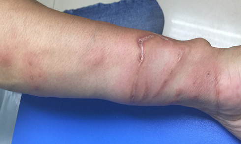 Bi sua can khi tam bien, phai lam gi?