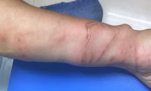 Bi sua can khi tam bien, phai lam gi?