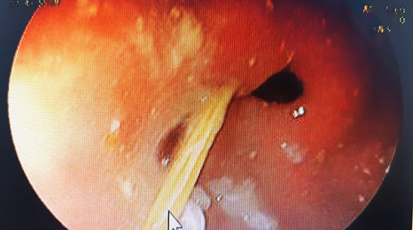 Quang Binh: Nuot nham tam tre gay thung da day