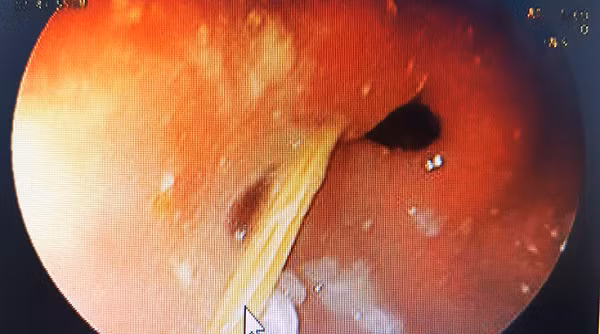 Quang Binh: Nuot nham tam tre gay thung da day