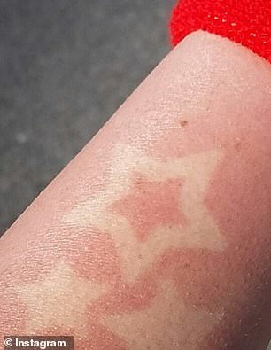 “Hinh xam chay nang“ - Canh bao xu huong lam dep nguy hiem-Hinh-2