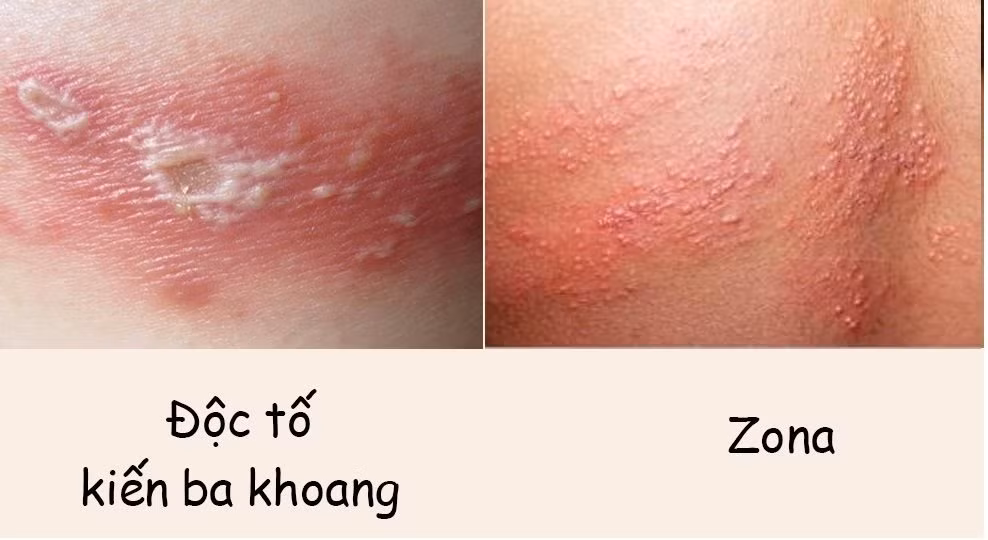 Vết đốt do kiến ba khoang gây ra thường có điểm trắng ở giữa.