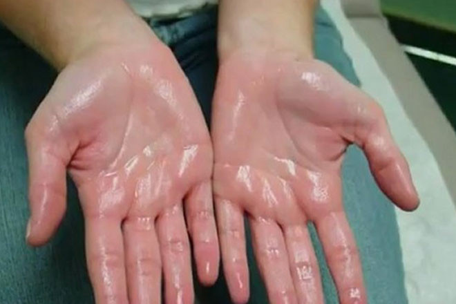 Thay 4 dau hieu nay tren co the, hay di kham ngay keo qua muon