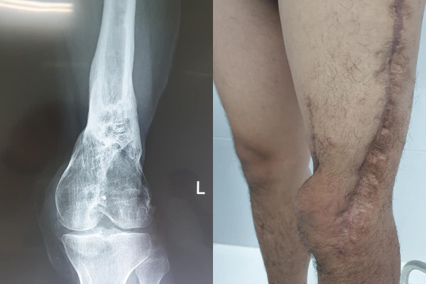 Hình ảnh chân trái của bệnh nhân trên phim X-quang cho thấy gần như bị hoại tử hết phía trong (trái) và đôi chân của bệnh nhân sau 7 lần phẫu thuật.