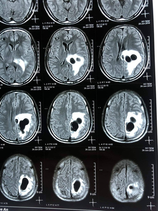 Liet nua nguoi, nao co 5 to san do mon 