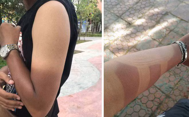 Tranh chay nang ngoai troi van chua du de ngua ung thu da