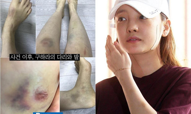 Loat minh tinh Han Quoc tung bi chong danh den muc phai nhap vien