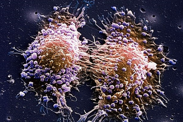 Một loại thuốc mới có thể khiến ung thư "ngủ quên". Ảnh: Mirror