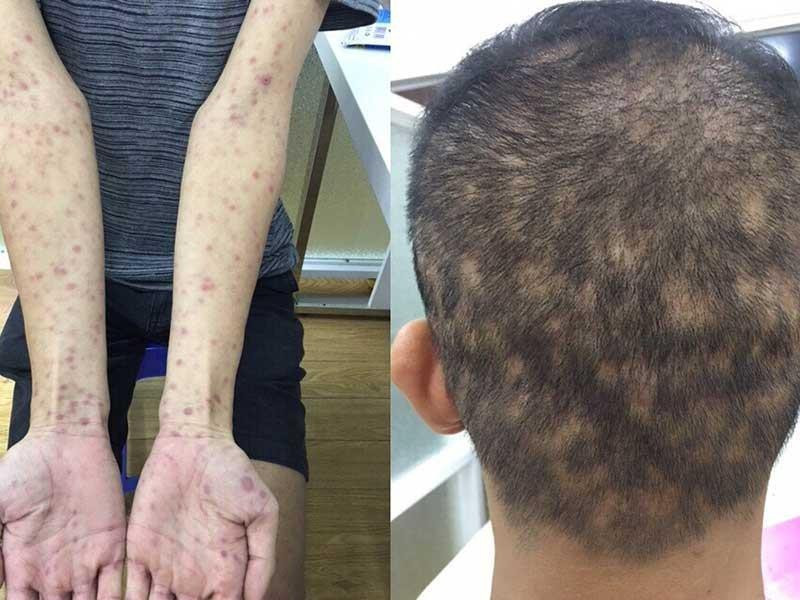 Tuỳ từng giai đoạn bệnh, các dấu hiệu, triệu chứng của bệnh giang mai rất khác nhau.