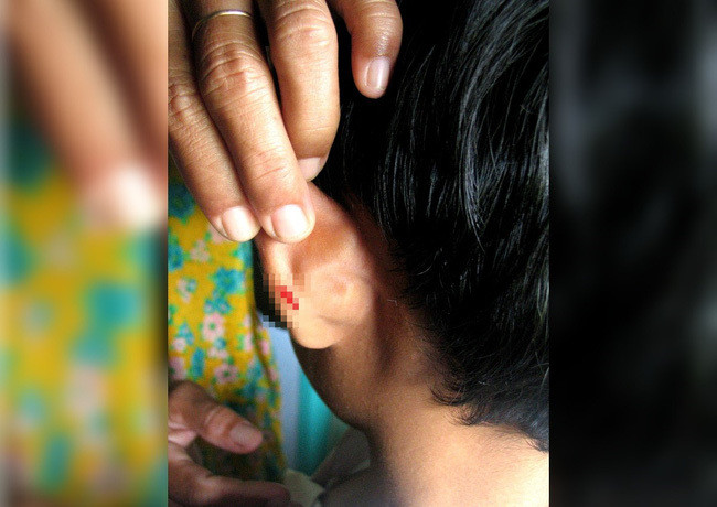 Giáo viên Malaysia dập ghim vào tai học sinh lớp 4 vì không làm bài tập về nhà.