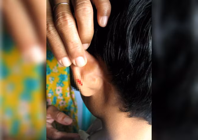 Giáo viên Malaysia dập ghim vào tai học sinh lớp 4 vì không làm bài tập về nhà.