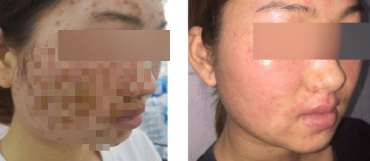 Da mat co gai sui nhu vo cay sau khi rua mat bang bot mua tren mang