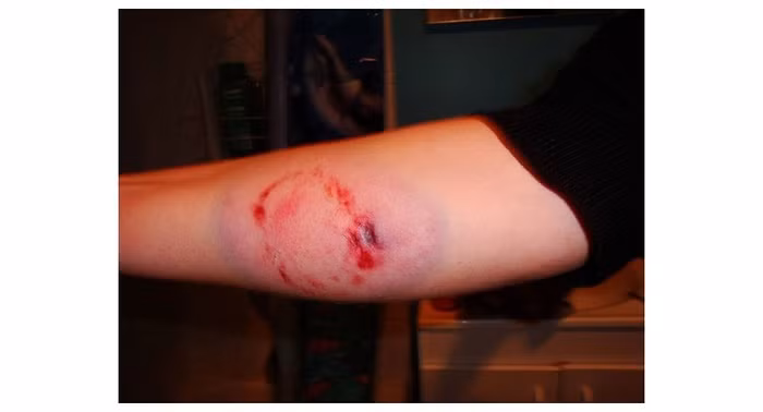 Vết cắn của người có thể gây hậu quả đáng sợ thế này đây - Hình 2 Vet can cua nguoi co the gay hau qua dang so the nay day-Hinh-2