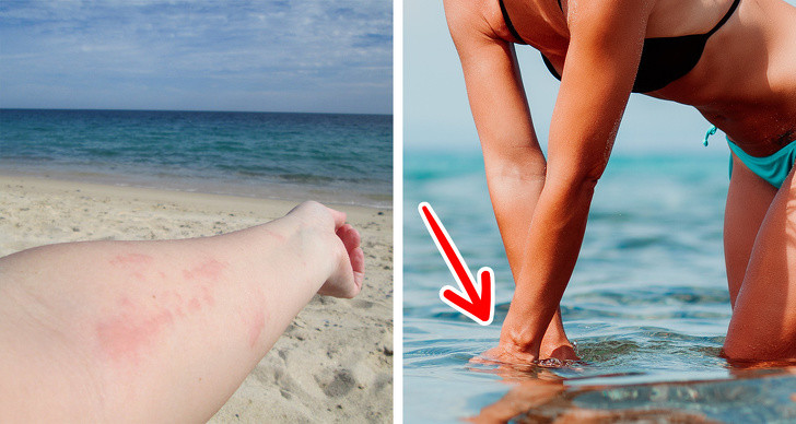 Sứa châm: Nếu bị sứa châm, bạn có thể rửa vết thương bằng nước muối, nước ấm, giấm, hoặc thoa hỗn hợp thuốc muối và nước lên vết thương. Than hoạt tính cũng có thể giúp hút độc sứa ra khỏi vết thương.