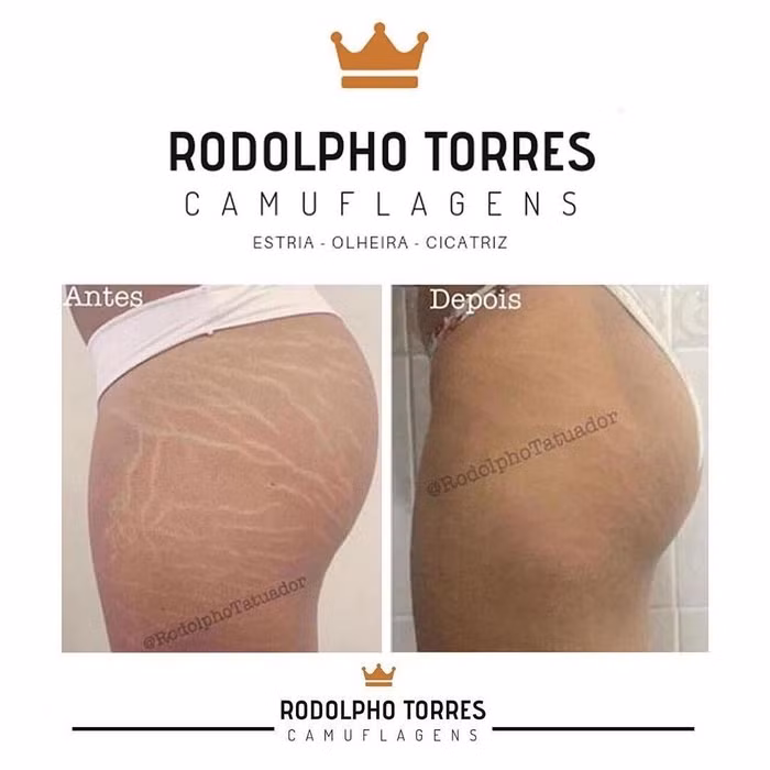 Hình xăm vết rạn da Rạn da là một vấn đề mà nhiều phụ nữ gặp phải. Một số người chịu đựng chúng và những người khác cố gắng tìm ra những cách mới để chống lại chúng. Rodolph Otatuador - nghệ sĩ xăm hình từ São Paolo đã tìm ra cách để che giấu vết rạn da. Anh ta lấp đầy những đường sẹo nhẹ nhất bằng màu cơ thể để trộn lẫn các vết rạn da với màu da. Và vết rạn da thực sự biến mất: sau khi chữa lành, làn da trông mịn màng hơn rất nhiều.