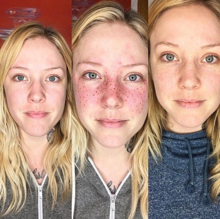 Xăm tàn nhang Những người bị tàn nhang từ khi sinh ra thường tự hào về tàn nhang và không che giấu chúng. Và những người kém may mắn hơn sẽ tìm cách để thêm tàn nhang vào khuôn mặt của họ. Một số người chỉ trang điểm để có tàn nhang và những người khác lại xăm tàn nhang. Xăm tàn nhang trông rất tự nhiên.