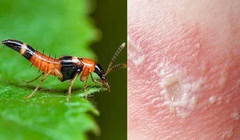 Hoang hon nam thanh nien tu chua benh ngoai da bang 