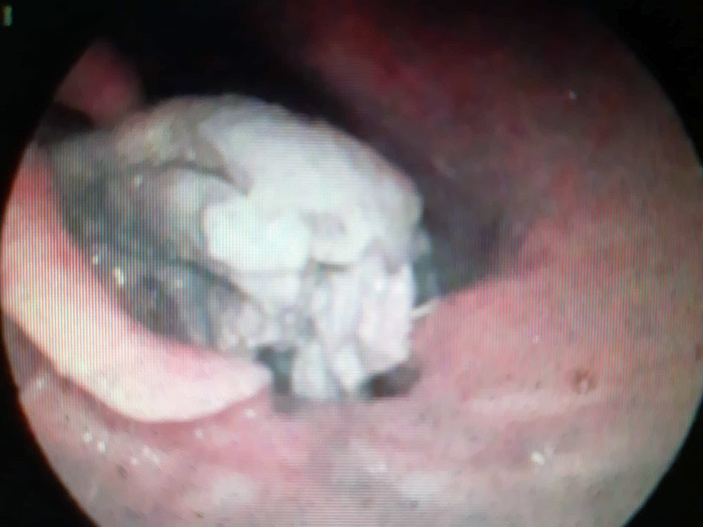 An phao cau vit, nguoi dan ong suyt mat mang