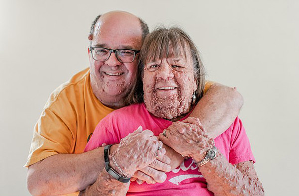 Nguoi phu nu co hang ngan khoi u moc tren nguoi tim duoc hanh phuc-Hinh-2