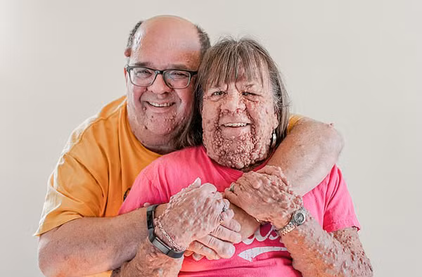 Nguoi phu nu co hang ngan khoi u moc tren nguoi tim duoc hanh phuc-Hinh-2