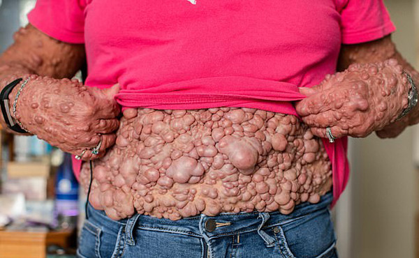 Nguoi phu nu co hang ngan khoi u moc tren nguoi tim duoc hanh phuc