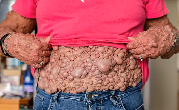 Nguoi phu nu co hang ngan khoi u moc tren nguoi tim duoc hanh phuc