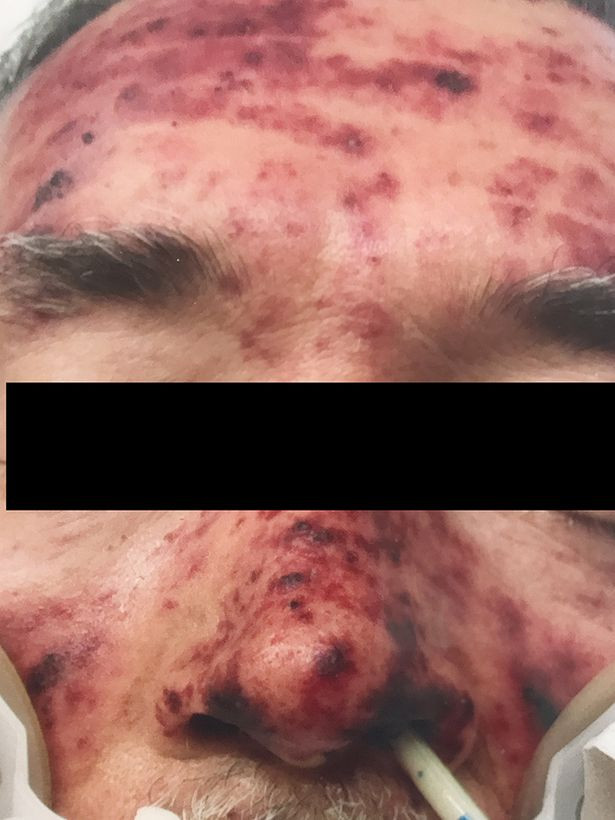 Người đàn ông tử vong sau 2 tuần nhập viện.