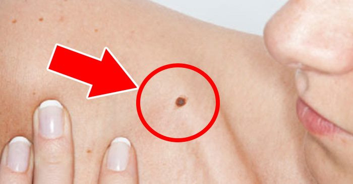 Co 1 trong 5 not ruoi cuc pham nay, doi cu the thang hoa