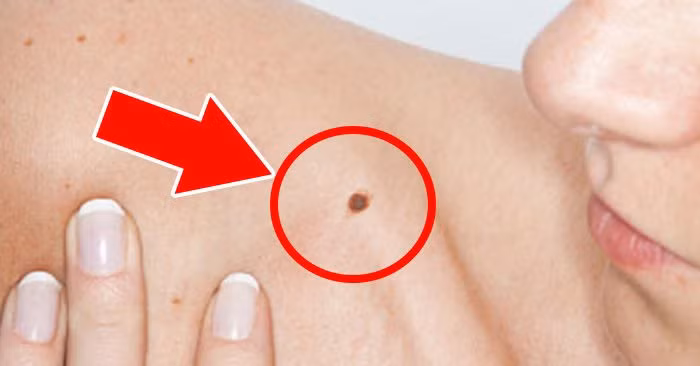 Co 1 trong 5 not ruoi cuc pham nay, doi cu the thang hoa