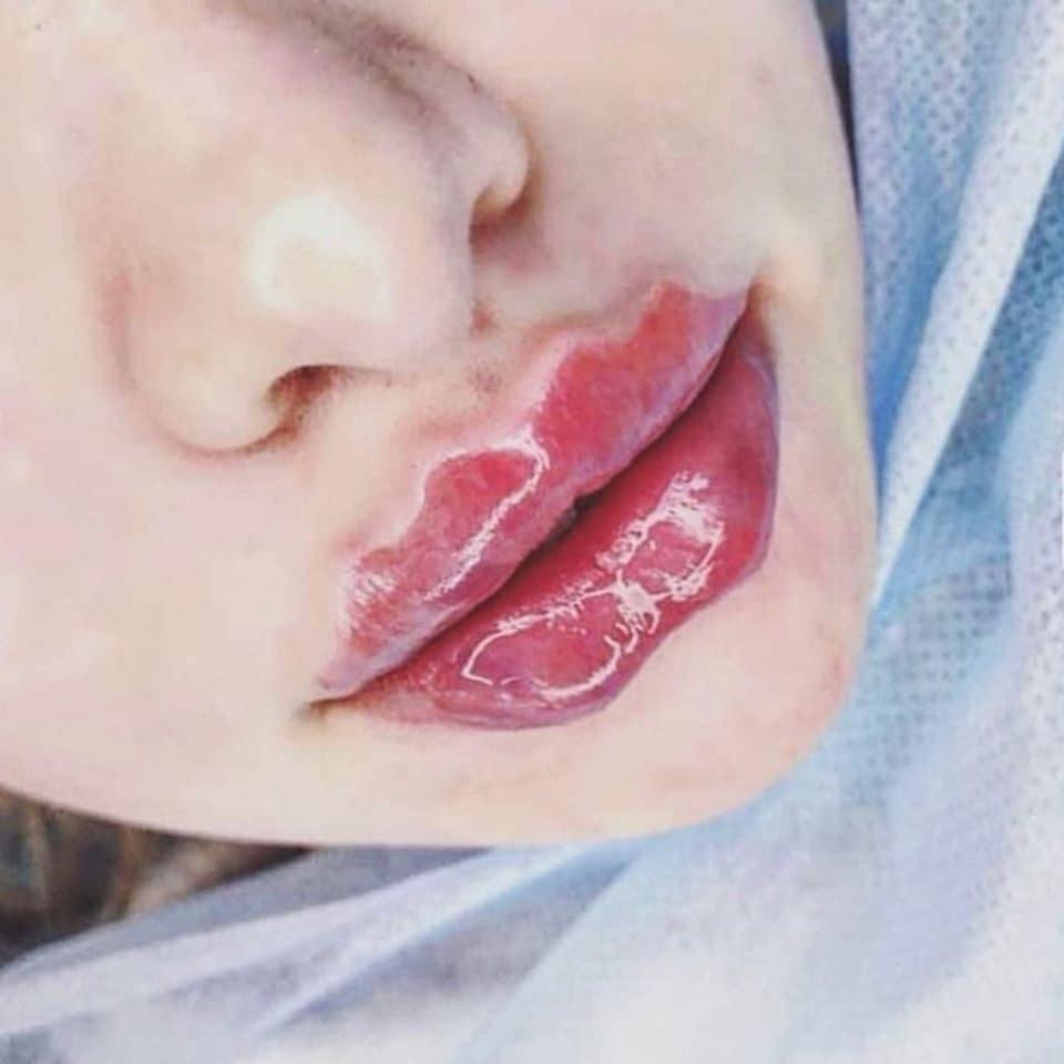 Để sở hữu hình dáng lạ mắt này, bạn phải tiêm filler vào phần viền môi.