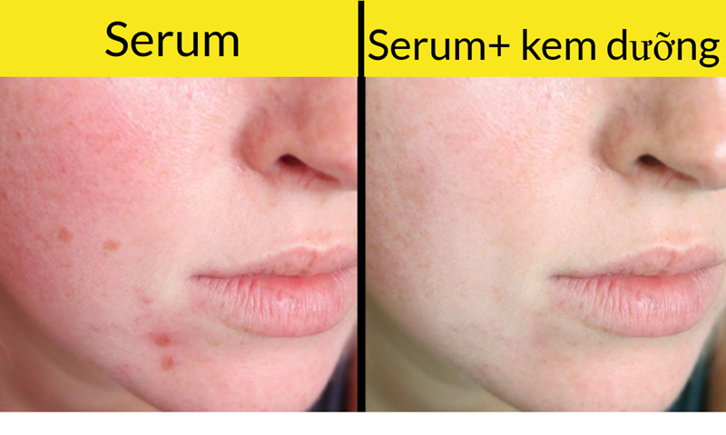 Serum (huyết thanh) nên được sử dụng trước khi bạn dùng kem dưỡng ẩm cho da. Và tốt hơn là nên dùng serum vào buổi tối, đặc biệt khi serum có chứa retinol. Điều này sẽ cho phép da hấp thụ đầy đủ các chất dinh dưỡng cần thiết. Vào mùa Hè, các sản phẩm giàu retinol sẽ làm cho da nhạy cảm với ánh nắng mặt trời và có thể gây ra cháy nắng, do vậy bạn nhất thiết phải sử dụng kem chống nắng.