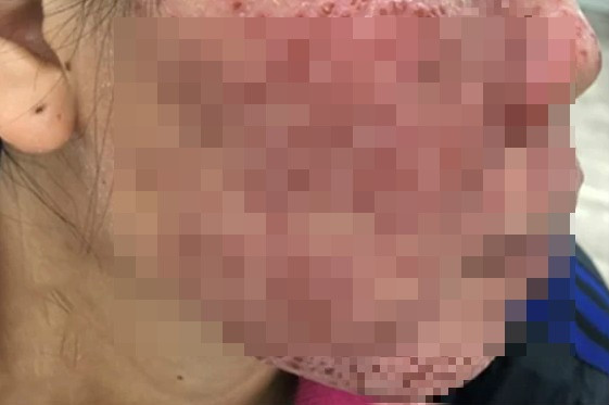 Da nổi mụn nước, mụn mủ, bong tróc sau khi lột da bằng vi tảo biển.