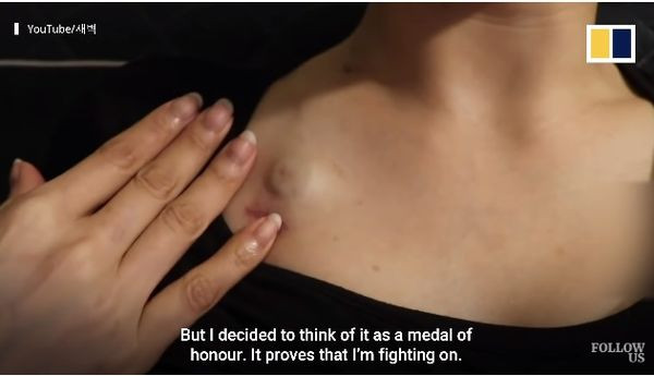 Móng tay cô bắt đầu đen đi. Cô được cấy 1 buồng tiêm tĩnh mạch dưới da. Chỗ tiêm bị sưng lên rất xấu. Cô rất ghét nó, nhưng cô xem đó là ”huy chương danh dự' trong quá trình chống chọi lại bệnh ung thư của mình.