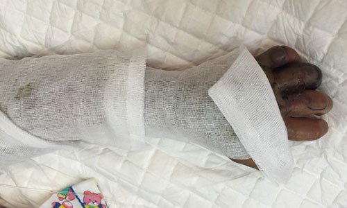 Dap thuoc la chua ran can, be trai bi hoai tu nang ban tay trai-Hinh-2