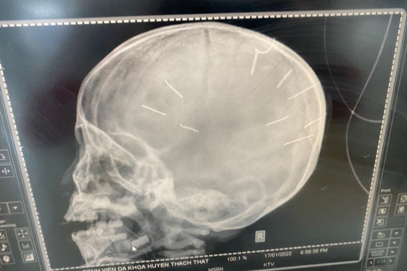 Be 3 tuoi nghi bi bao hanh, 9 di vat gam o dau: Can khoi to vu an