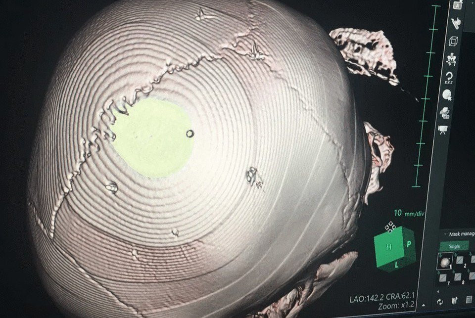 Theo thông tin ban đầu còn cho thấy, trong quá trình cháu về chung sống cùng mẹ và đối tượng thì đã bị đối tượng nhiều lần hành hung, đánh đập dã man với mục đích sát hại cháu bé nhưng do cháu được đưa đi cấp cứu kịp thời nên may mắn không tử vong. Đối với những hành vi tàn ác sát hại cháu không thành thì đối tượng sẽ phải chịu thêm tình tiết định khung tăng nặng Phạm tội (Giết người) 02 lần trở lên theo quy định tại điểm g, Khoản 1 Điều 52 Bộ luật hình sự. 