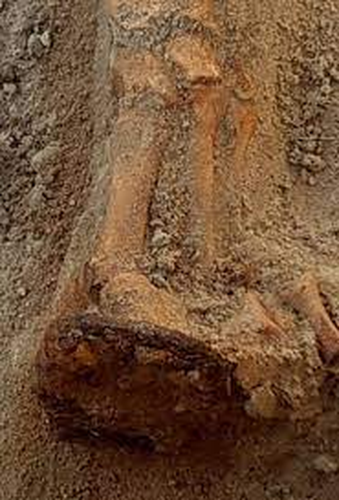 Trong thời đại trung cổ, sự hiểu biết hạn chế về các bệnh truyền nhiễm và di truyền đã dẫn đến đối xử phân biệt đối với những người mắc bệnh, thậm chí sau khi họ chết, khiến cho họ bị cáo buộc là ma cà rồng.